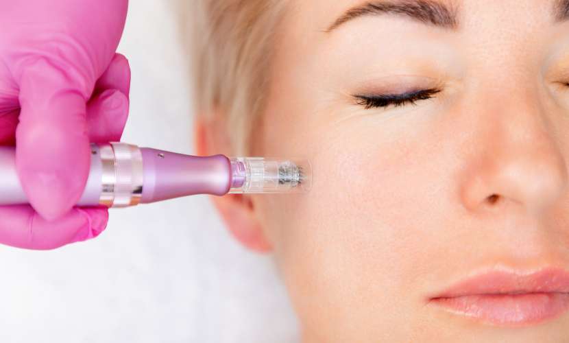 microneedling